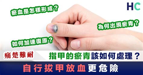 腳指甲受傷|指甲瘀青要冰敷、拔掉嗎？醫師揭正確處理方法，出現…